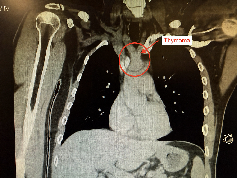 CT scan image showing the thymus and tumor