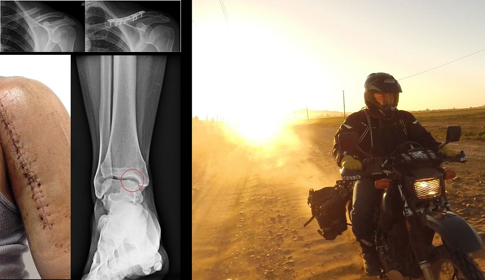 The aging rider: Every scar tells a story